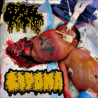 Lipoma - Lipoma/Calcified Fetus