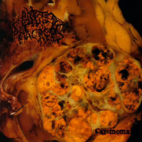 Blasted Pancreas - Carcinoma