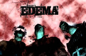 Edema