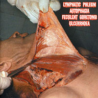 Lymphatic Phlegm - 4-Way Split CD